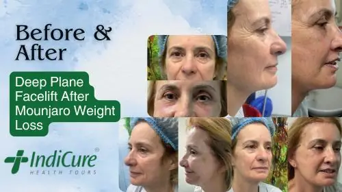 Before after results of deep plane facelift after mounjaro weight loss Before after results of deep plane facelift after mounjaro weight loss
